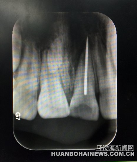 X光片顯示縫衣針扎入牙齒根管。